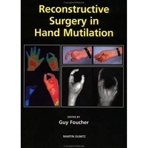 Reconstructive Surgery In Hand Mutilation 