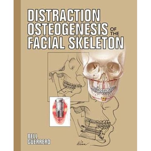 Distraction Osteogenesis Of The Facial Skelet...