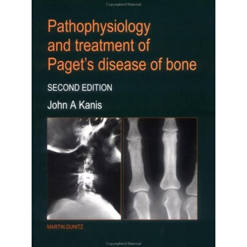 Pathophysiology And Treatment Of Paget'S Dise...