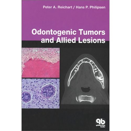 Odontogenic Tumours And Allied Lesions (Hb 20...