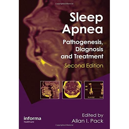 Sleep Apnea Pathogenesis Diagnosis And Treatm...