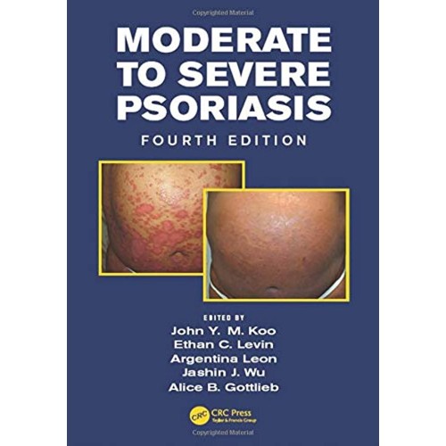 Moderate To Severe Psoriasis 4Ed (Hb 2014) 