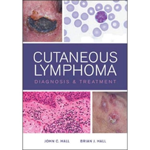 Cutaneous Lymphoma Diagnosis And Treatmnet (H...