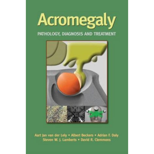 Acromegaly Pathology Diagnosis And Tretment 