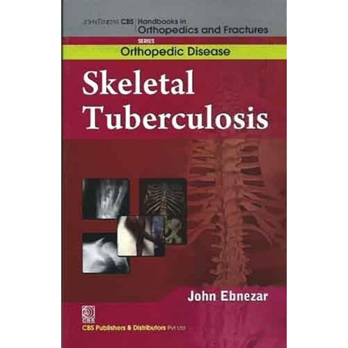 Skeletal Tuberculosis (Handbooks In Orthopedi...