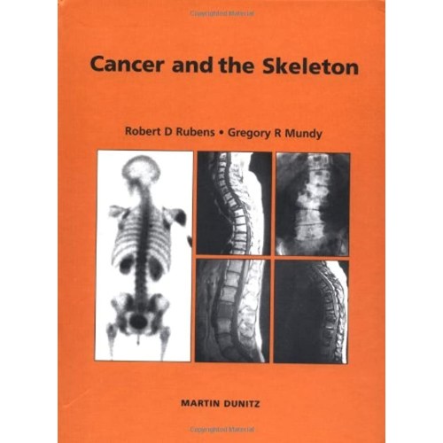 Cancer And Skeleton 