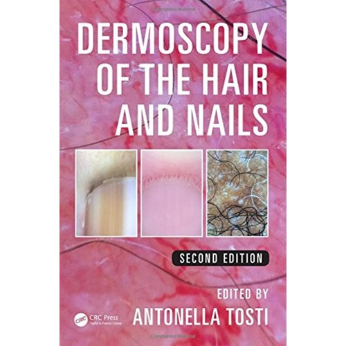 Dermoscopy Of The Hair And Nails 2Ed (Hb 2016...