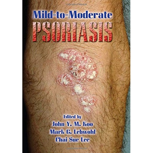 Mild To Moderate Psoriasis 