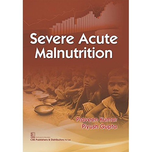 Severe Acute Malnutrition (Pb 2017) 