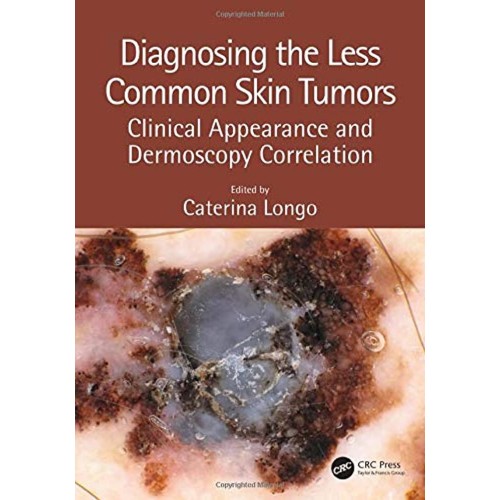 Diagnosing The Less Common Skin Tumors Clinic...