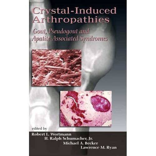 Crystal-Induced Arthropathies: Gout, Pseudogo...