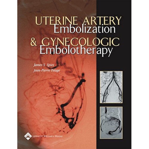 Uterine Artery Embolization & Gynecologic Emb...