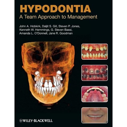 Hypodontia: A Team Approach To Management 