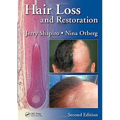 Hair Loss And Restoration 2Ed (Hb 2015) 