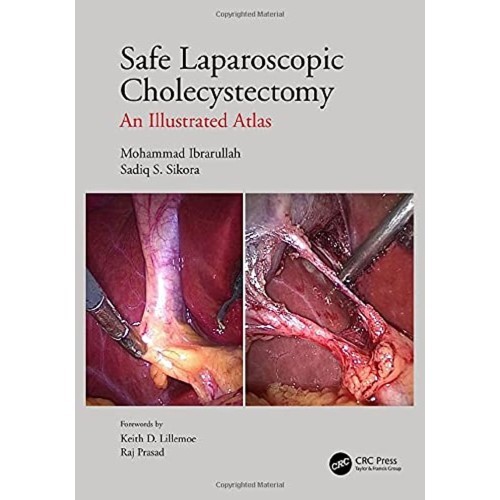 Safe Laparoscopic Cholecystectomy An Illustra...