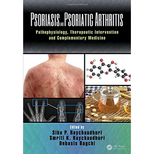 Psoriasis And Psoriatic Arthritis Pathophysio...