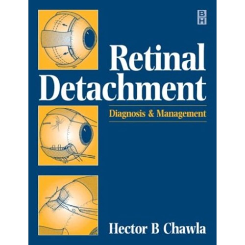 Retinal Detachment : The Essentials Of Manage...