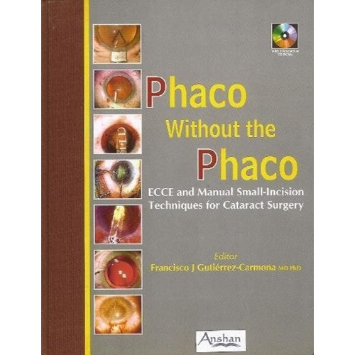 Phaco Without The Phaco 