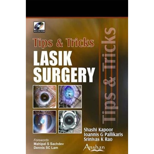 Lasik Surgery Tips & Tricks 