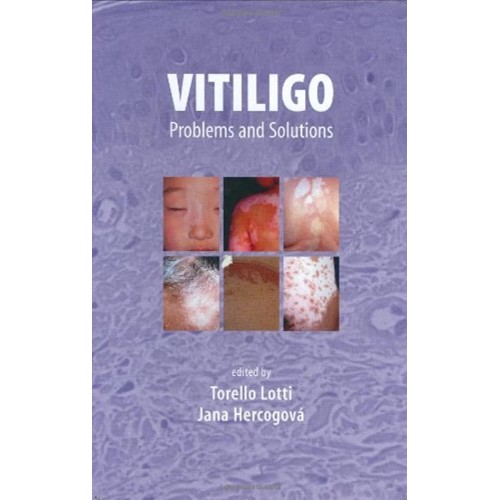 Vitiligo: Problems And Solutions (Basic And C...