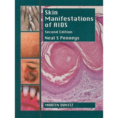 Skin Manifestations Of Aids 