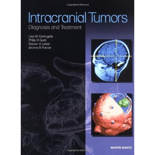 Intracranial Tumors: Diagnosis And Treatment 