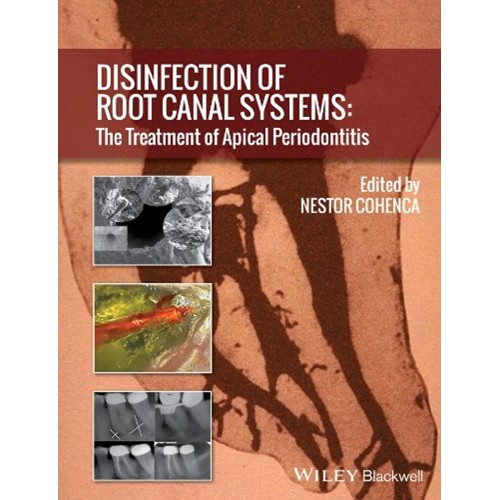 Disinfection Of Root Canal Systems: The Treat...