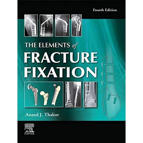 The Elements Of Fracture Fixation With Access...