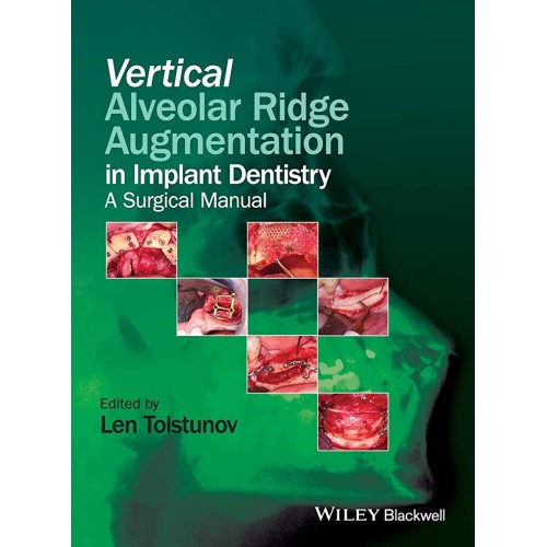 Vertical Alveolar Ridge Augmentation In Impla...