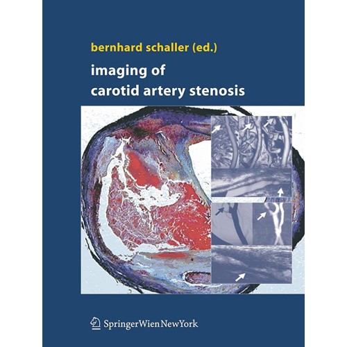 Imaging Of Carotid Artery Stenosis (Hb) 