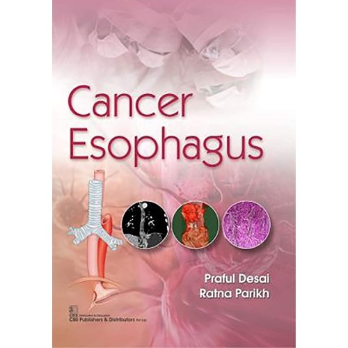 Cancer Esophagus (Pb 2020) 