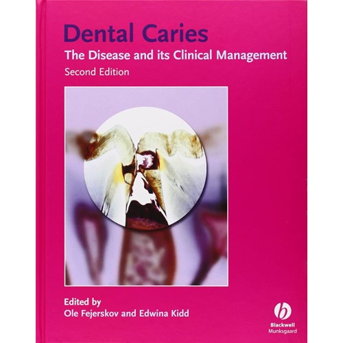 Dental Caries 2Ed The Disease And Its Clinica...