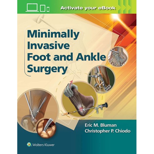 Minimally Invasive Foot And Ankle Surgery (Hb...