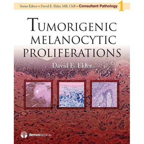 Tumorigenic Melanocytic Proliferations Vol 1 ...