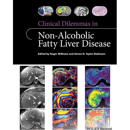 Clinical Dilemmas In Non Alcoholic Fatty Live...