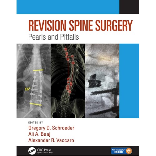 Revision Spine Surgery Pearls And Pitfalls Wi...