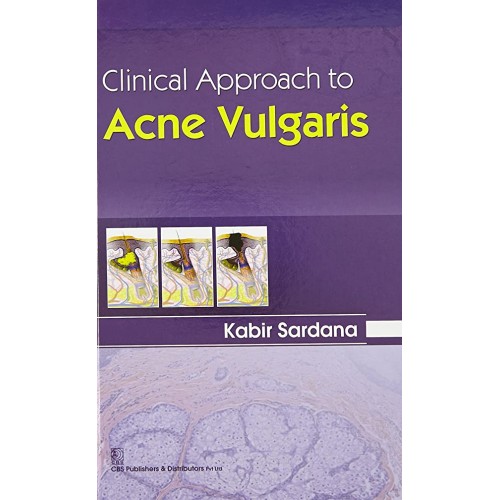 Clinical Approach To Acne Vulgaris (2015) 