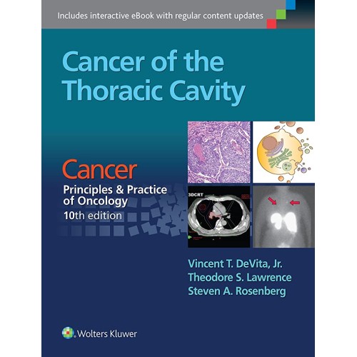 Cancer Of The Thoracic Cavity Cancer: Princip...