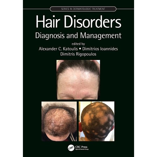 Hair Disorders Diagnosis And Management (Hb 2...