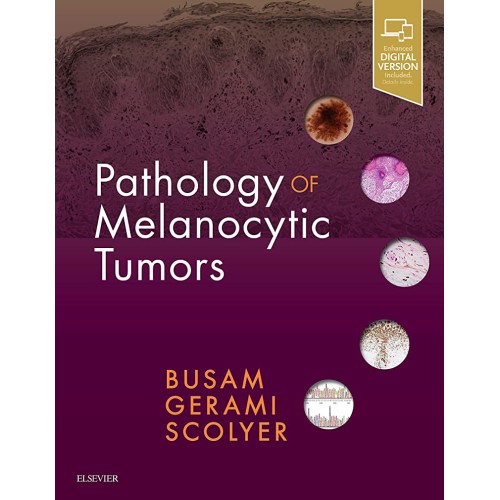 Pathology Of Melanocytic Tumors With Access C...