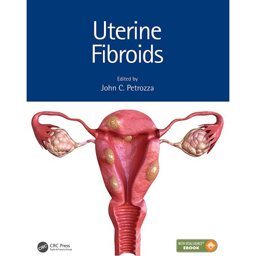 Uterine Fibroids (Hb 2021)