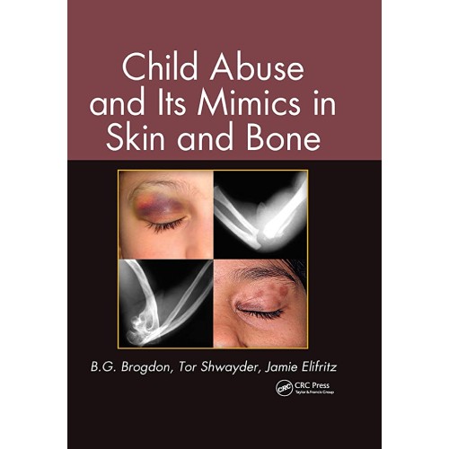 Child Abuse And Its Mimics In Skin And Bone (...