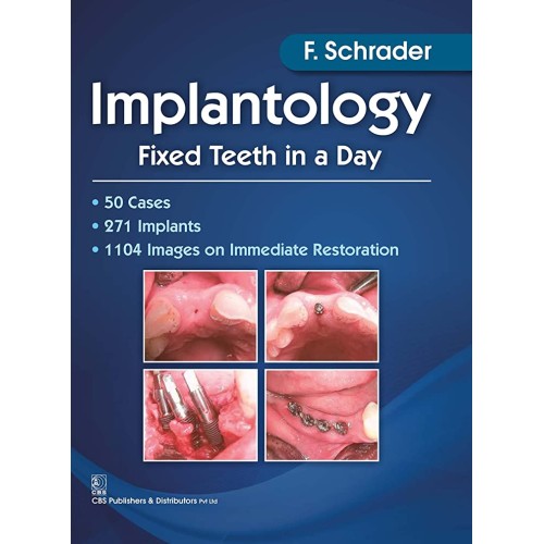 Implantology Fixed Teeth In A Day (Pb 2017) 