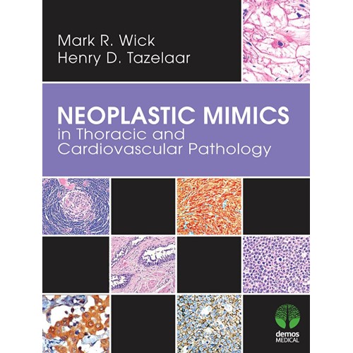 Neoplastic Mimics In Thoracic And Cardiovascu...