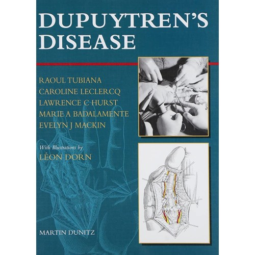 Dupuytren'S Disease 