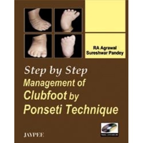 STEP BY STEP MANAGEMENT OF CLUBFOOT BY PONSET...