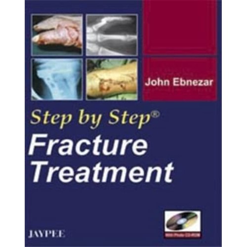 STEP BY STEP FRACTURE TREATMENT WITH PHOTO CD...