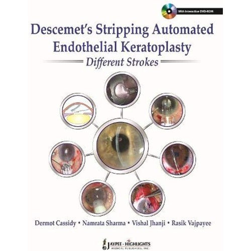 DESCEMET'S STRIPPING AUTOMATED ENDOTHELIAL KERATOPLASTY:DIFFERENT STROKES