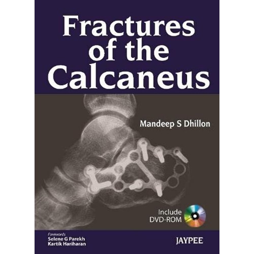 FRACTURES OF THE CALCANEUS WITH DVD-ROM