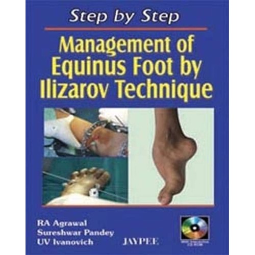 STEP BY STEP MANAGEMENT OF EQUINUS FOOT BY IL...